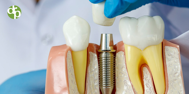 construcción implante dental