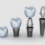 fases en el proceso de implantes dentales