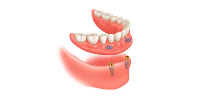 2 implantes sobre dentadura