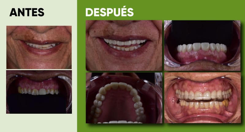 antes y después estética dental