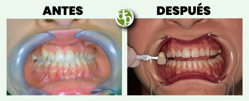 antes después ortodoncia y blanqueamiento dental