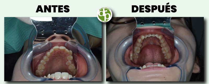 antes después-estética dental y ortodoncia