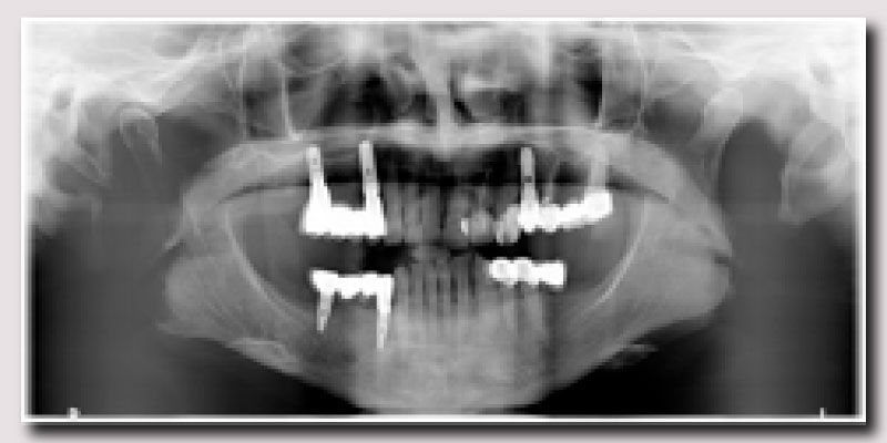 radiografía puente sobre implantes