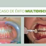 caso éxito multidisciplinar ortodoncia y estética dental